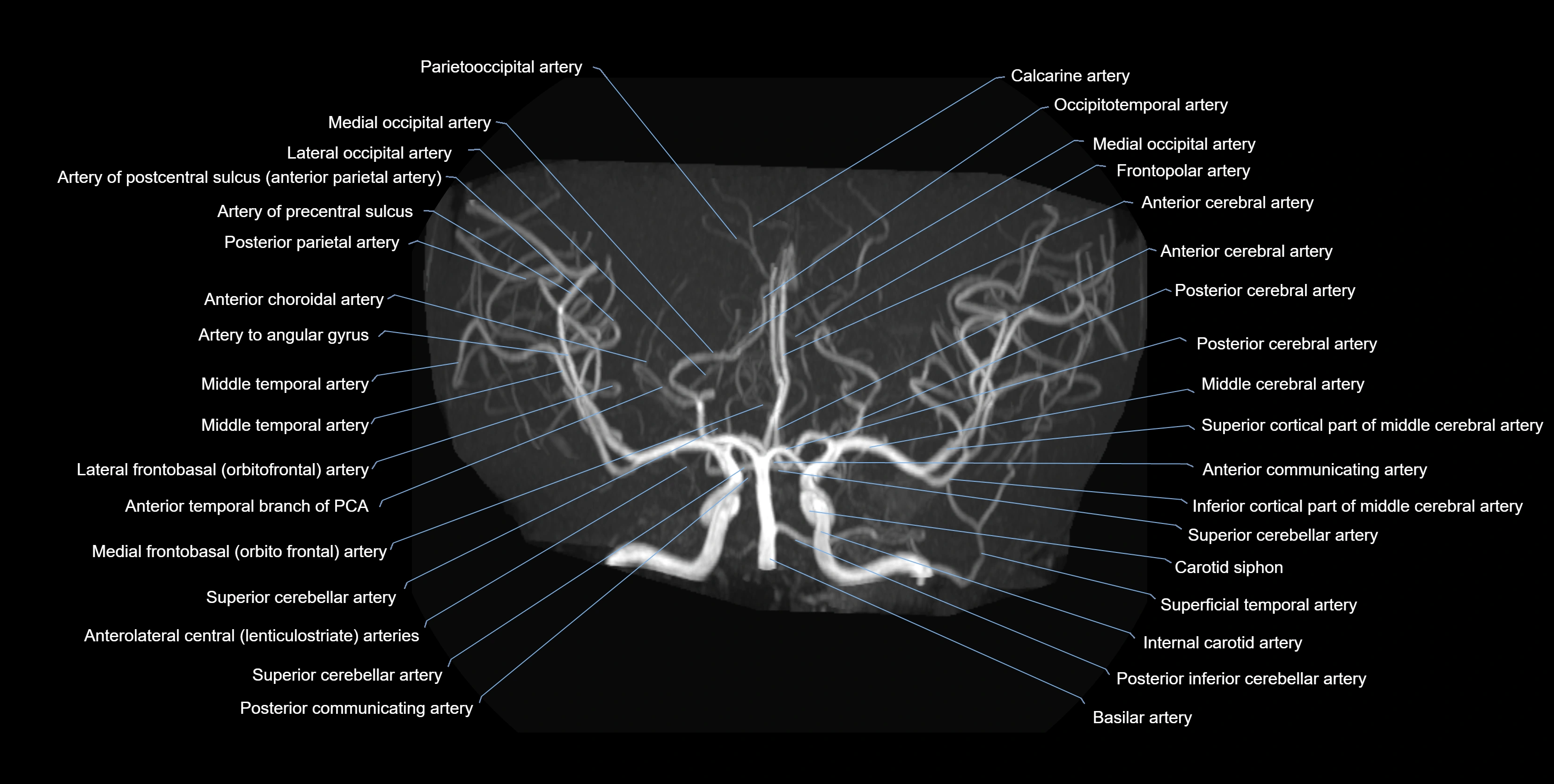 MRA brain axial MIP labelled  anatomy 3T MRI images -img-01021-00010.webp